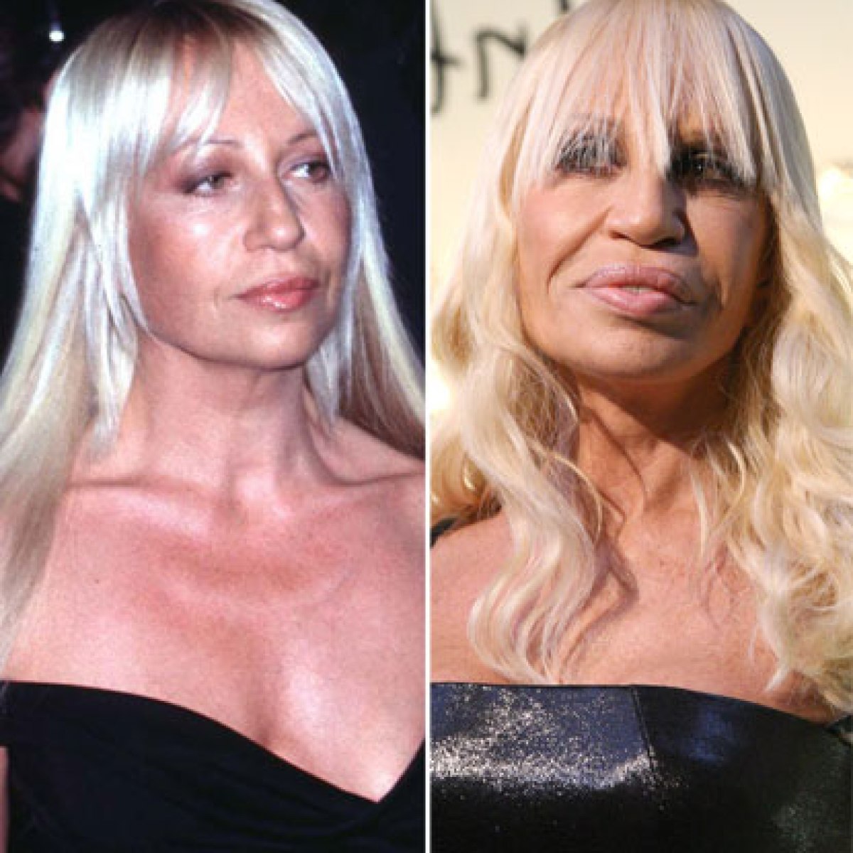10 epic celebrity plastic surgery disasters