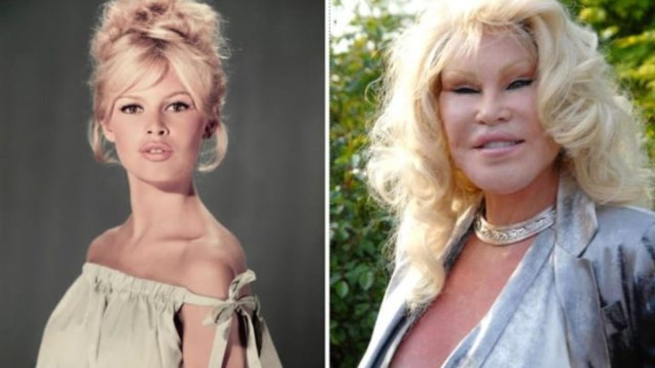 10 Epic Celebrity Plastic Surgery Disasters Mixtrends 