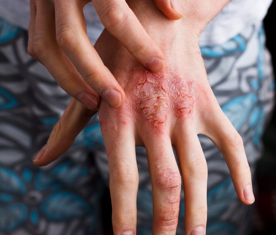 5 Most Common Atopic Dermatitis Causes You Should Be Aware Of