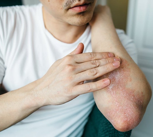 10 Signs That You Suffer From Plaque Psoriasis