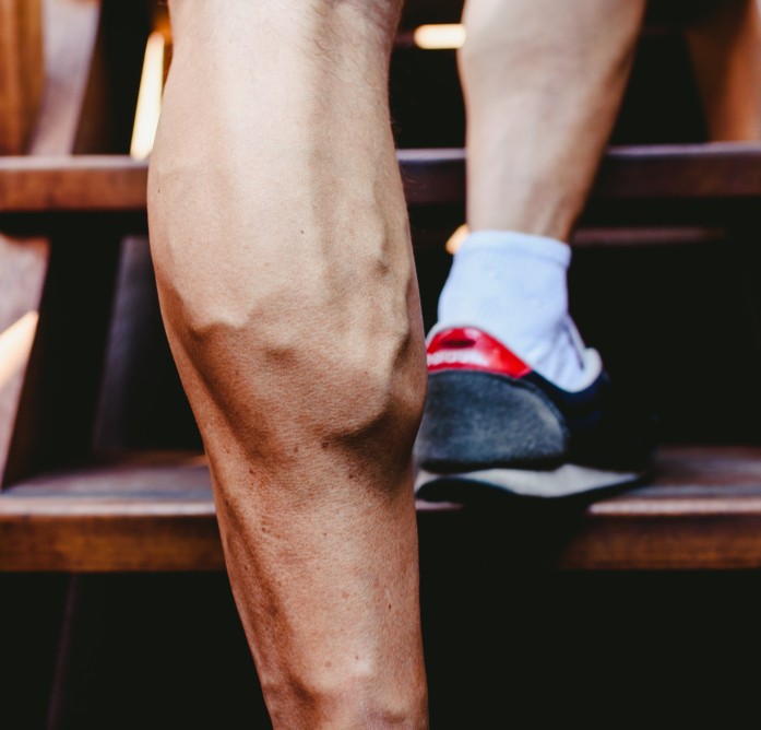 Ready to Get Rid of Varicose Veins? Here is How