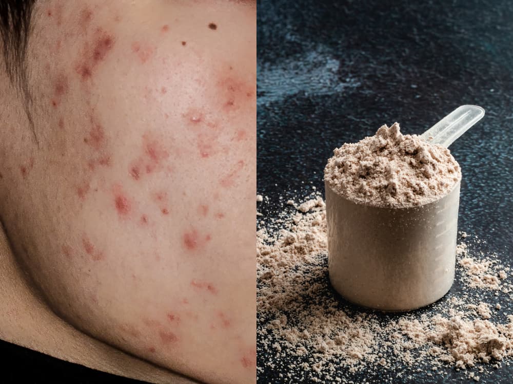 7 Supplements That Can Cause Acne